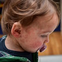 toddler with measles